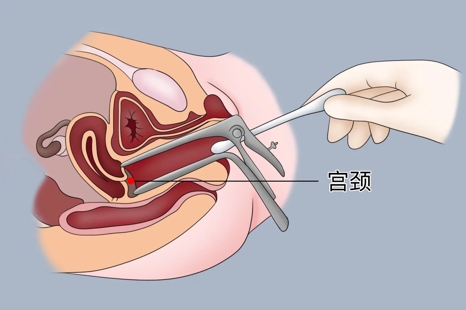 刮宫手术怎么做图解