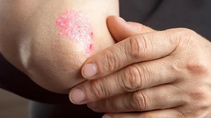 治疗牛皮癣的偏方有哪些