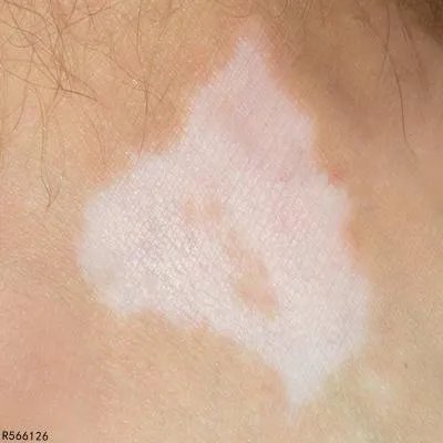 白癜风白斑变红怎么办