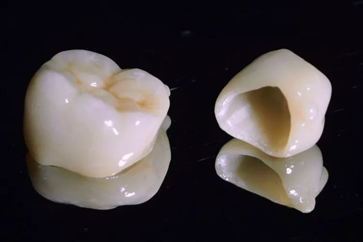 单颗牙套有几种图片