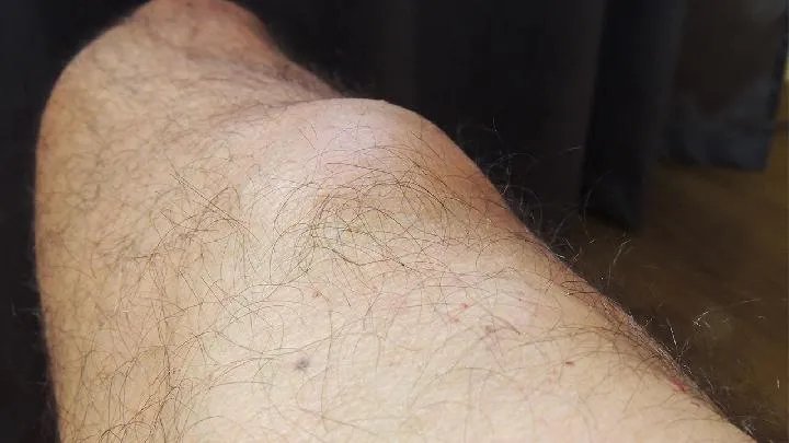 黄褐斑是什么样子的 这些样子或许正在困扰着你