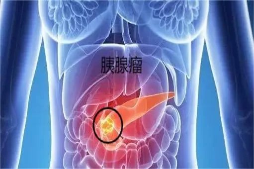 胰腺瘤在人体的哪个部位图解