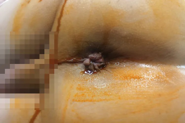 痔疮轻度与重度的图片