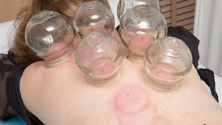 黄褐斑和雀斑多见于什么症状？