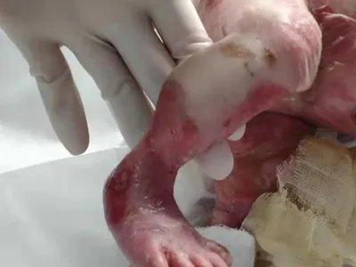 葡萄球菌性烫伤样皮肤综合征糜烂图片