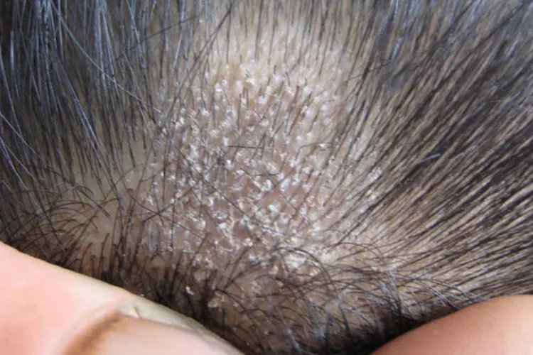 各种皮癣的图片大全