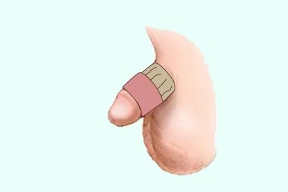 小儿包皮手术后图片