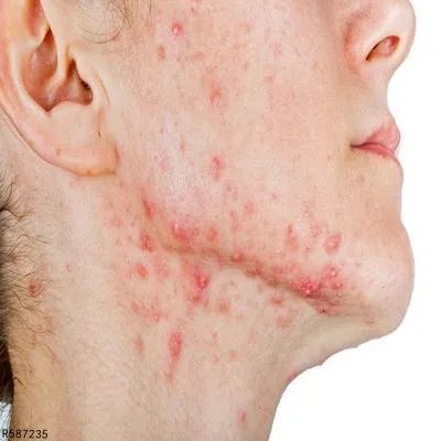 脂溢性痤疮是怎么回事