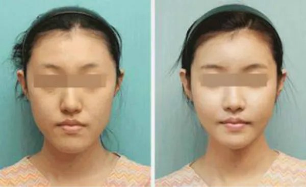 脂肪填充脸部注意事项