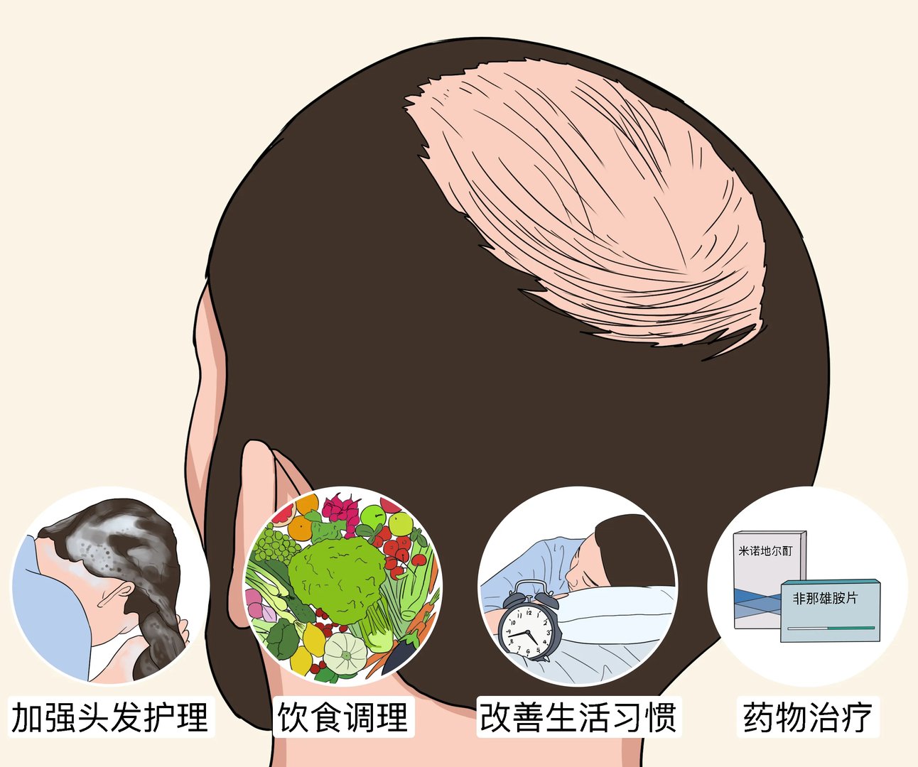 脂溢性脱发怎么缓解