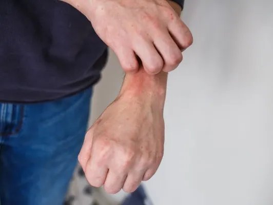 手背长斑的原因