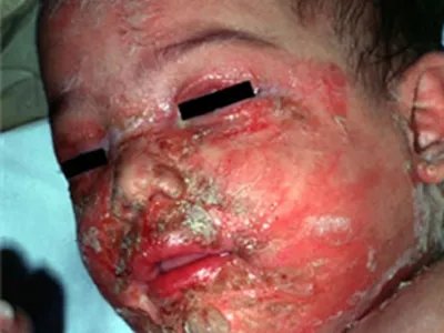 葡萄球菌性烫伤样皮肤综合征糜烂图片