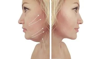 自体脂肪填充副作用有哪些