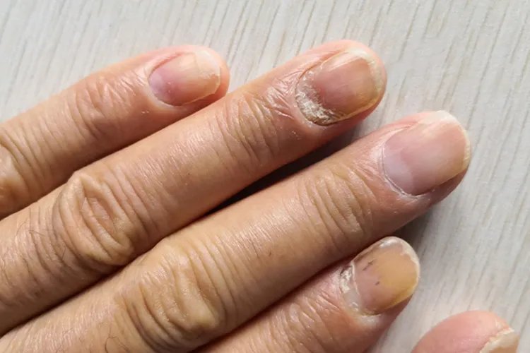 怎么确定是不是灰指甲图片