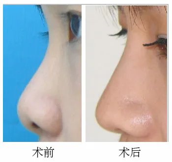 朝天鼻矫正的方法