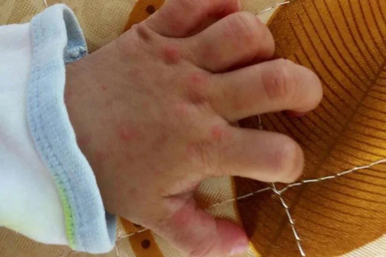 幼儿手足口病的图片