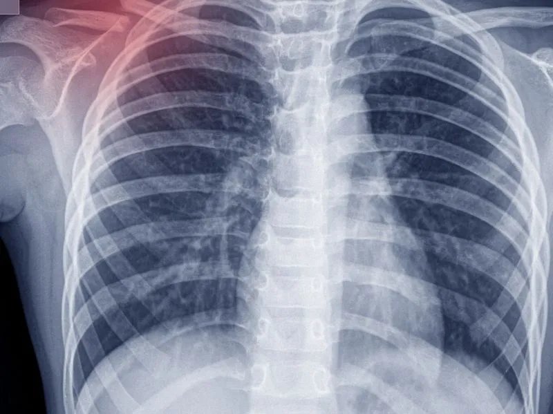 肺鳞癌晚期能活多久