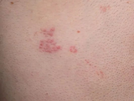 疱疹样湿疹的保健