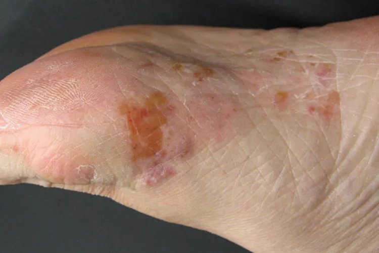 各种皮癣的图片大全