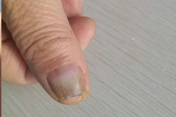 灰指甲由轻到重的图片