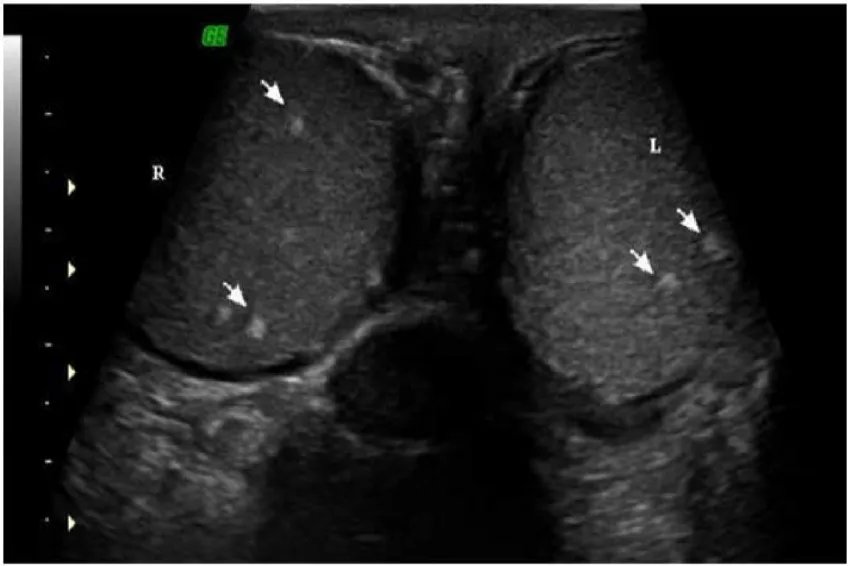 正常婴儿的蛋蛋的图片