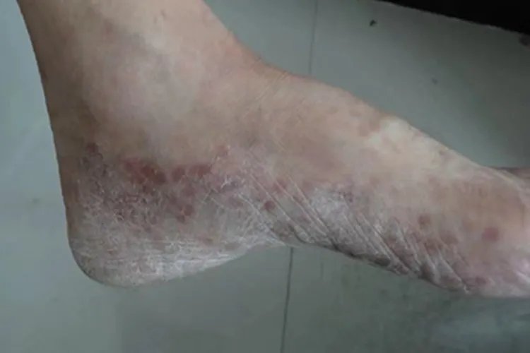 鳞屑角化型足癣皮肤粗糙图片