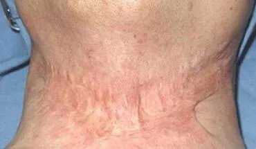 烫伤疤痕修复要多久