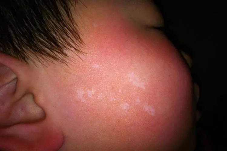 婴儿轻度白癜风图片