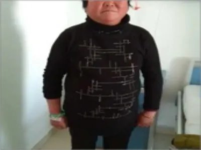 库欣综合征腹部肥胖图片