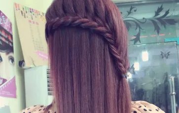 秃顶植发大概多少钱