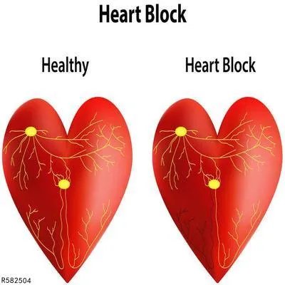 什么是慢性心包炎 从3个症状了解慢性心包炎