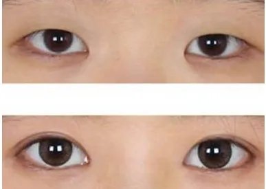 开眼角前后对比照片