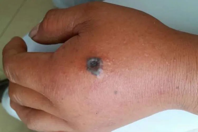 皮肤炭疽病的症状图片