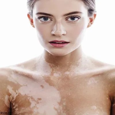 白癜风手术前注意哪些