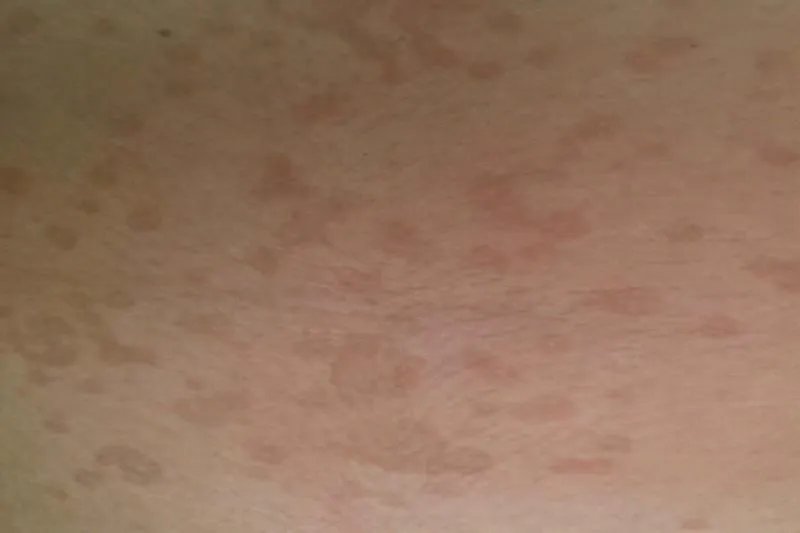 皮肤圆圈癣图片