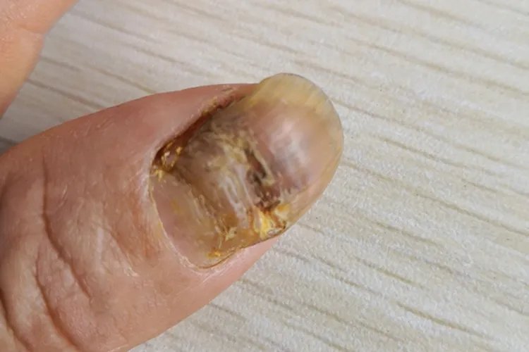 怎么确定是不是灰指甲图片