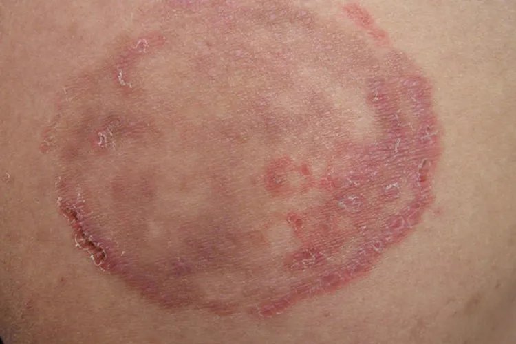 各种皮癣的图片大全