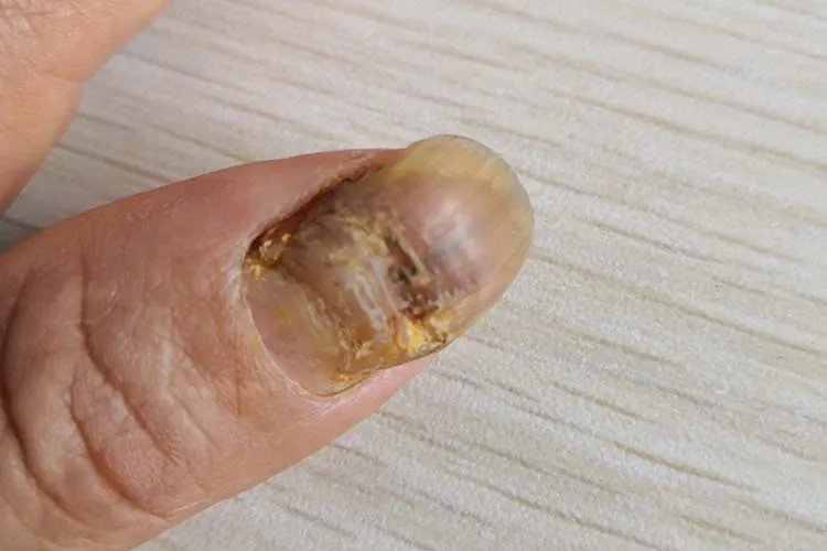 灰指甲由轻到重的图片