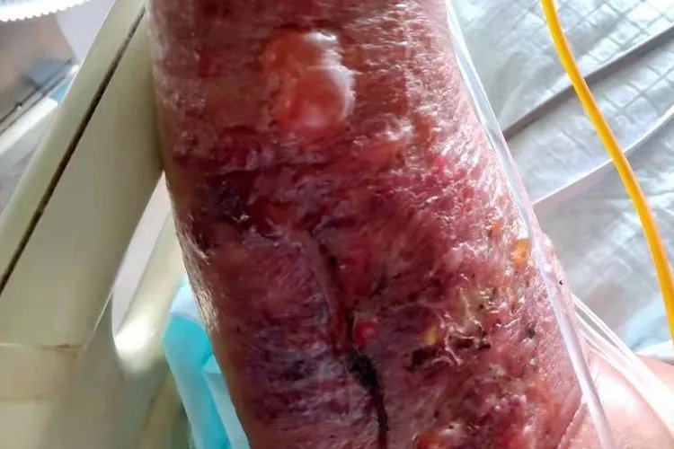 皮肤炭疽病的症状图片