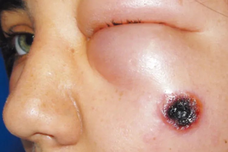 皮肤炭疽病的症状图片