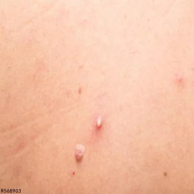 背上长的红疙瘩是怎么回事