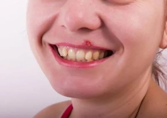 唇周边长痘用什么药膏