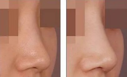 鼻子整形术要多少钱