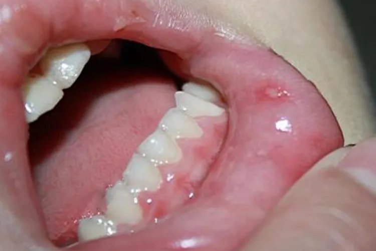 幼儿手足口病的图片