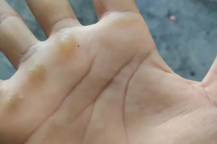 女生手起茧子图片