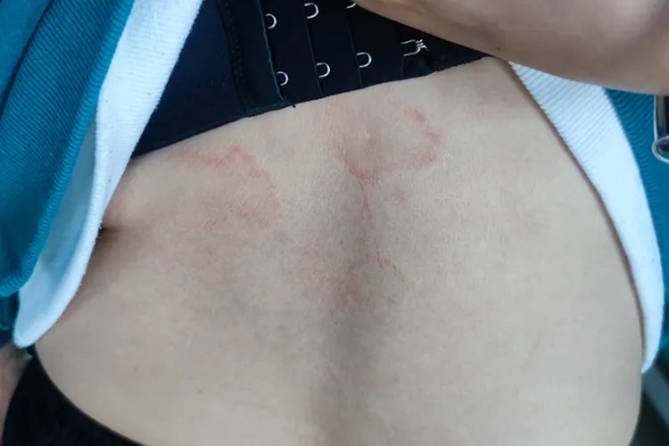 各种皮癣的图片大全