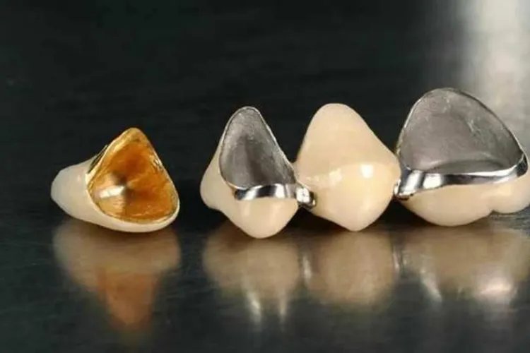 单颗牙套有几种图片