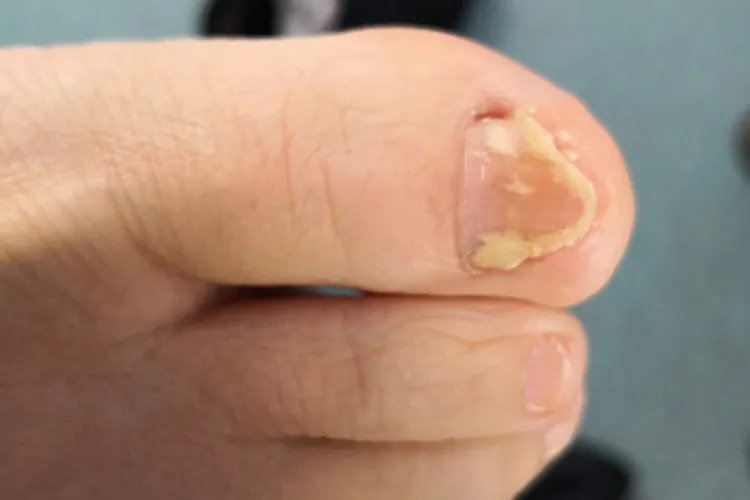 各种皮癣的图片大全