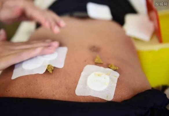 三伏贴多少钱一张 2017年三伏贴的价格