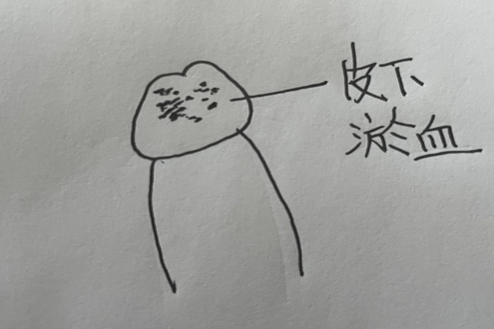 包皮环切手术术后水肿图片